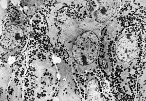 F, 41y. | acromegaly - acidophilic pituitary adenoma (STH)